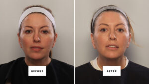 Can You Fake a Blepharoplasty? I Gave It My Best Shot.